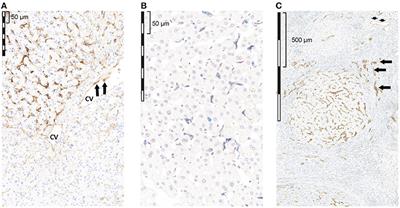 Observational Study of PD-L1, TGF-β, and Immune Cell Infiltrates in Hepatocellular Carcinoma